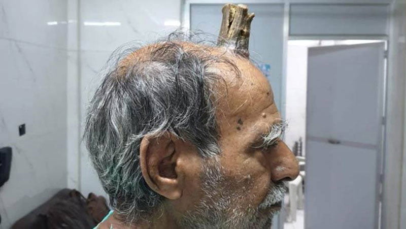 মানুষেরও শিং গজায়! - West Bengal News 24