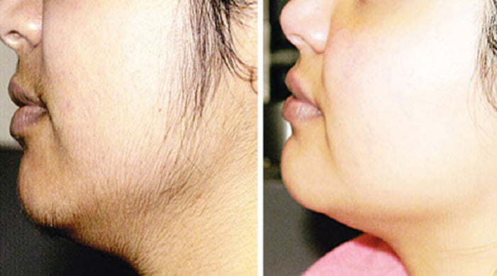 সহজেই দূর করুন অবাঞ্ছিত লোম! - West Bengal News 24 সহজেই দূর করুন অবাঞ্ছিত লোম! - West Bengal News 24