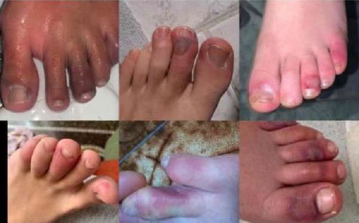 পায়ে র‍্যাশ, জ্বালাপোড়া হতে পারে কোভিডের লক্ষণ, সতর্ক করছেন ডাক্তাররা ! - West Bengal News 24