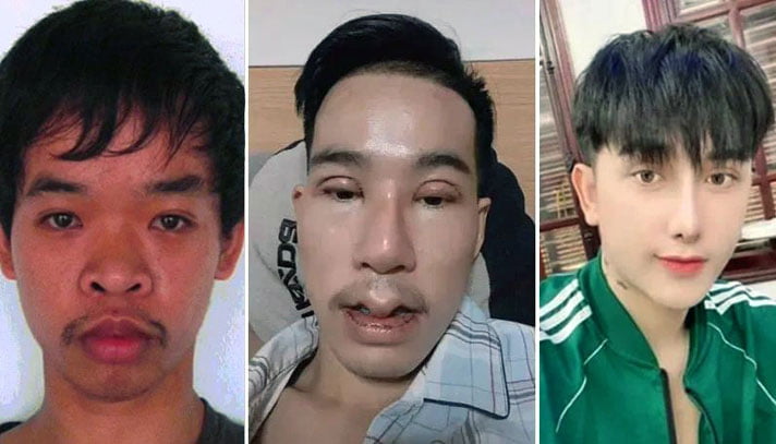 দেখতে খারাপ তাই হাসাহাসি, সার্জারিতে চেহারা বদল - West Bengal News 24