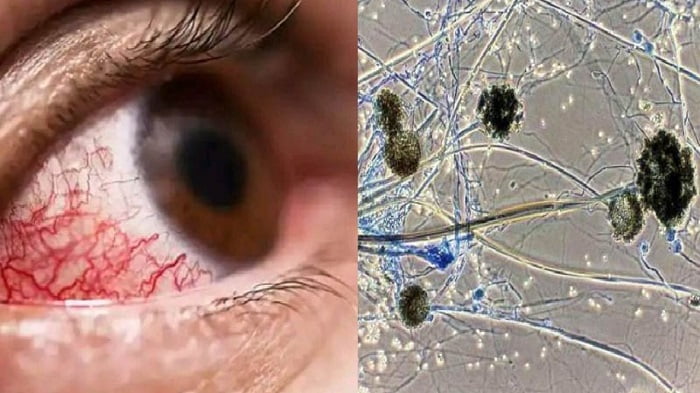 ব্ল্যাক ফাঙ্গাসে সংক্রমিত হওয়ার ঝুঁকিতে যারা - West Bengal News 24 ব্ল্যাক ফাঙ্গাসে সংক্রমিত হওয়ার ঝুঁকিতে যারা - West Bengal News 24