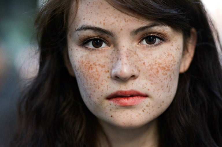 ঘরোয়া কিছু উপায়েই দূর করুন ছুলি - West Bengal News 24