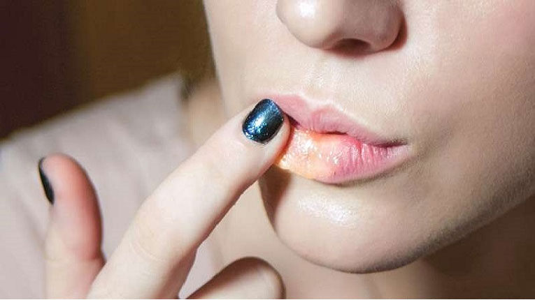 শীতে ঠোঁট ফাটার সমস্যা কীভাবে এড়াবেন? - West Bengal News 24 শীতে ঠোঁট ফাটার সমস্যা কীভাবে এড়াবেন? - West Bengal News 24